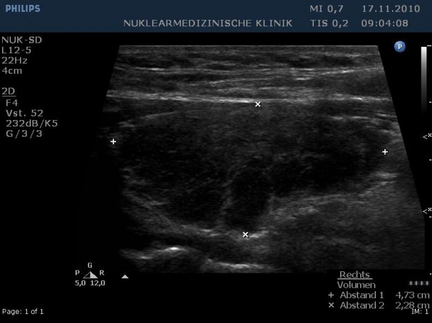 Hashimoto Thyreoiditis