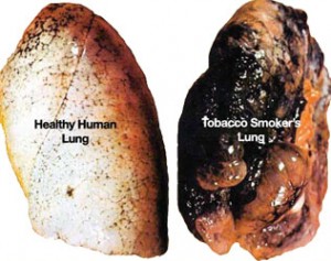 Healthy lung vs. smokers lung Healthy lung vs. smokers lung