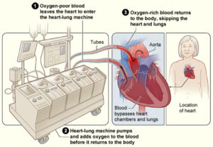 heart-lung bypass