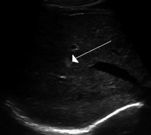 Hemangioma of the liver as seen on ultrasound