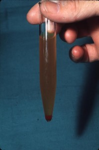 Hematuria Hematuria