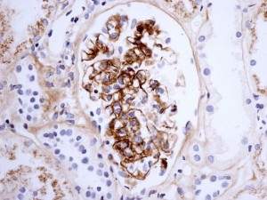Henoch-Schönlein-nephritis
