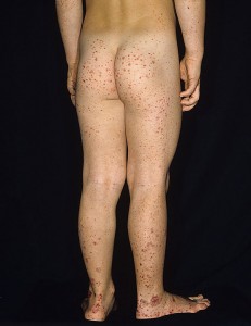 Henoch-schonlein purpura Henoch-schonlein purpura