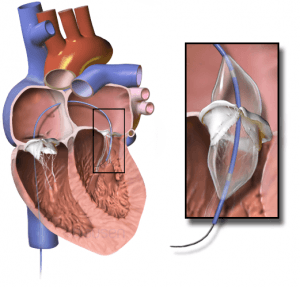 Heart valve repair