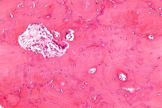 High magnification micrograph of Paget's disease of the bone