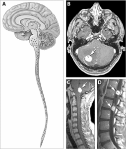 von hippel lindau disease