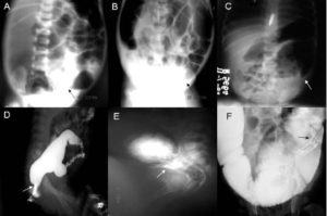 hirschsprung's disease