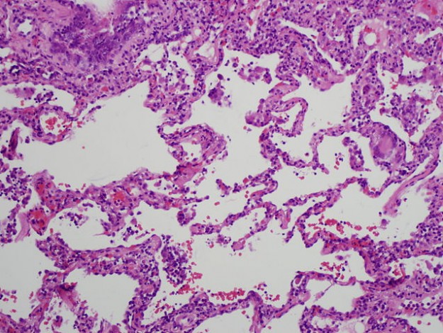 Histology of chronic hypersensitivity pneumonitis Histology of chronic hypersensitivity pneumonitis