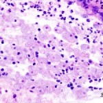 Histopathologic image of amoebic dysetery found in endoscopic colonic biopsy Histopathologic image of amoebic dysetery found in endoscopic colonic biopsy