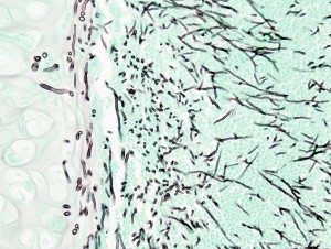 Grocott's methenamine silver stain image of pulmonary invasive aspergillosis