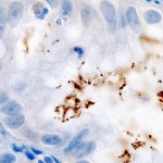Histopathology of Helicobacter pylori infection in a gastric foveolar pit demonstrated in endoscopic gastric biopsy Histopathology of Helicobacter pylori infection in a gastric foveolar pit demonstrated in endoscopic gastric biopsy