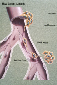 Metastasis Illustration