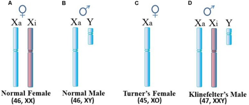 Turner Syndrome Gonadal Dysgenesis — Diagnosis And Management