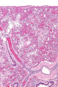 Hyaline membranes Hyaline membranes