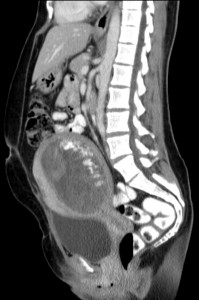 Hydatid sagittal CT image Hydatid sagittal CT image