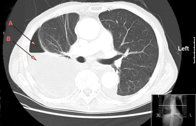 experimental mesothelioma treatment