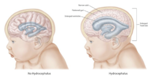 Hydrocephalus