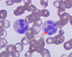 Hypersegmented neutrophils seen in megaloblastic anemia
