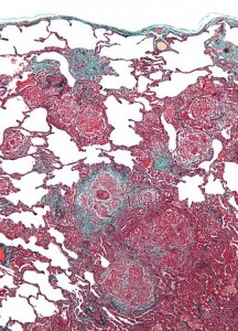 Hypersensitivity pneumonitis intermed mag Hypersensitivity pneumonitis intermed mag