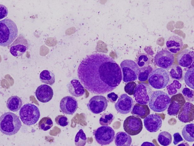 Hypolobated small megakaryocyte Hypolobated small megakaryocyte