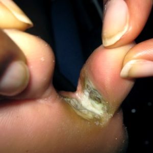 intertrigo interdigital candidiasis