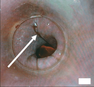 Intra-operative endoscopic view of the repair result Intra-operative endoscopic view of the repair result