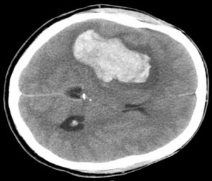Intraparenchymal bleed with edema