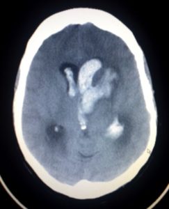 Humagem intracerebral e intraventricular