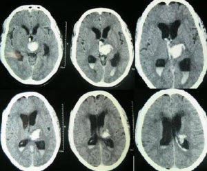 Intracerebral hemorrhage