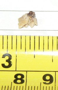 Kidney Stone