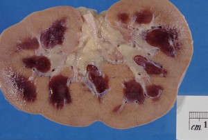 Kidney–acute-cortical-necrosis