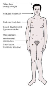 klinefelter's syndrome