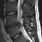 L4-l5-disc-herniation