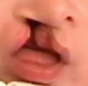 cleft lip and palate