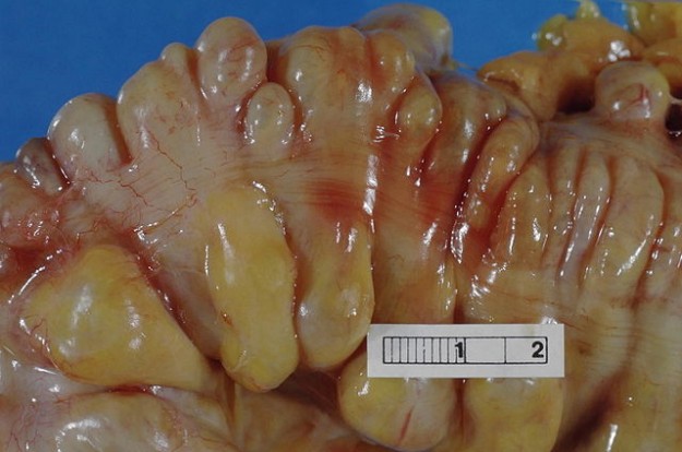 Large bowel (sigmoid colon) showing multiple diverticula Large bowel (sigmoid colon) showing multiple diverticula