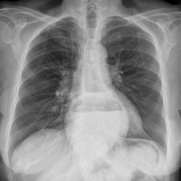 Large hiatal hernia in the thorax screen