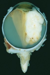 Large retinoblastoma, infiltrating a large part of the glass body and the lens Large retinoblastoma, infiltrating a large part of the glass body and the lens
