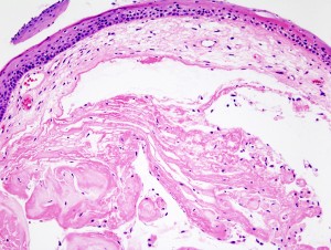 vocal nodules