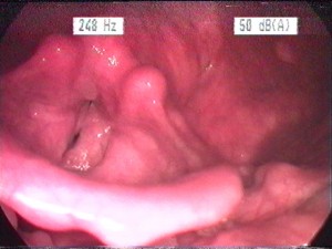 Laryngitis gastrica