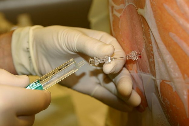 Liquor reflux through 25 G spinal needle in spinal anesthesia