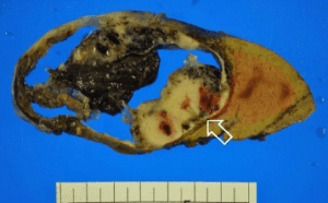 Macroscopic picture of a Ewing's sarcoma Macroscopic picture of a Ewing's sarcoma