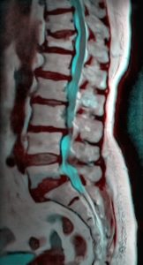 Lumbar-MRI-Spinal-injuries