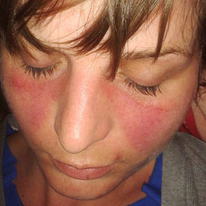 Image: “Butterfly erythema in systemic lupus.” by Doktorinternet - Own work. License: CC BY-SA 4.0