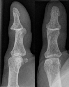 Joint dislocation of interphalangeal joint of the thumb