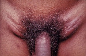 Lymphogranuloma venerum is caused by the invasive serovars L1, L2, or L3 of Chlamydia trachomatis.