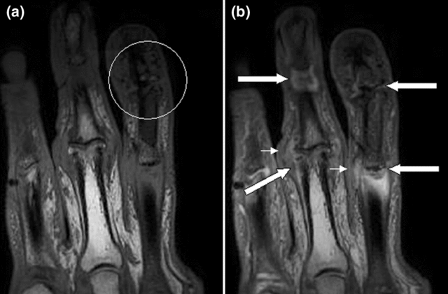 Magnetic resonance images of the fingers in psoriatic arthritis
