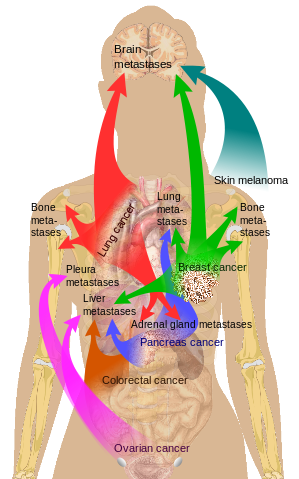 Main sites of metastases for common cancer types