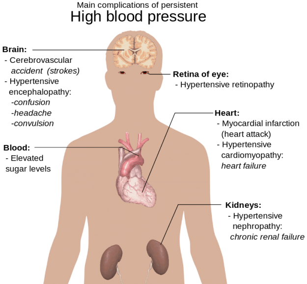 Main complications of persistent high blood pressure Main complications of persistent high blood pressure