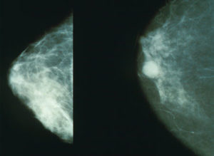 Mammography breast cancer