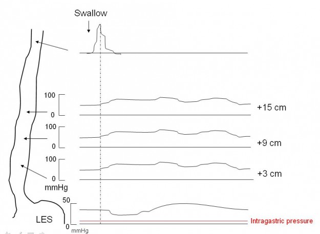 Manometric schematic of achalasia demonstrating aperistaltic contractions Manometric schematic of achalasia demonstrating aperistaltic contractions